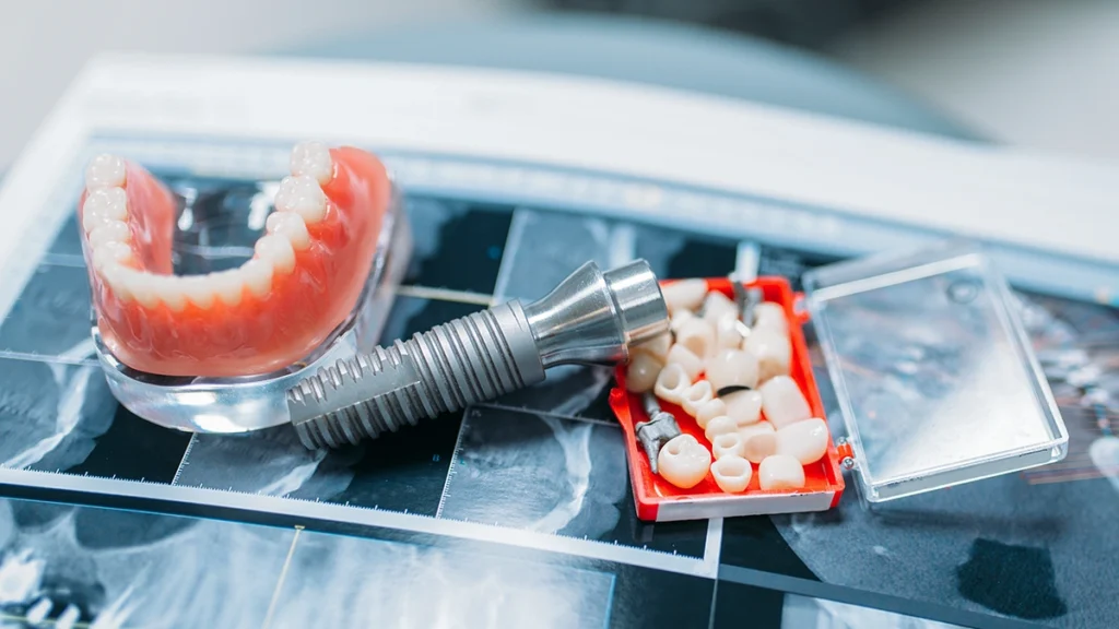 Dental implant model with crowns and denture illustrating long-term implant restoration