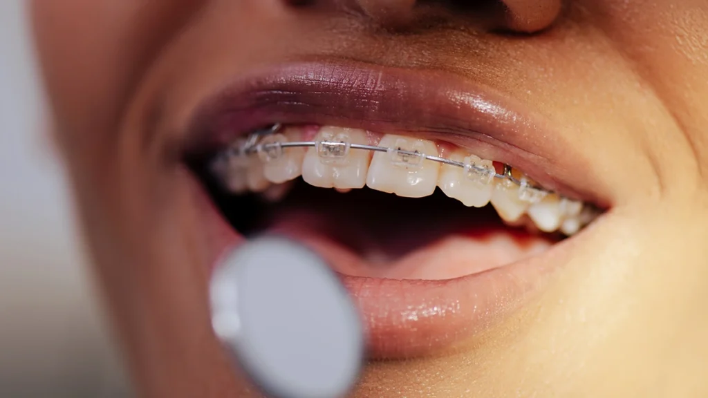 Ceramic braces on teeth during orthodontic treatment