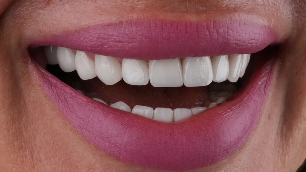 Close-up of a smile illustrating chipped tooth repair options