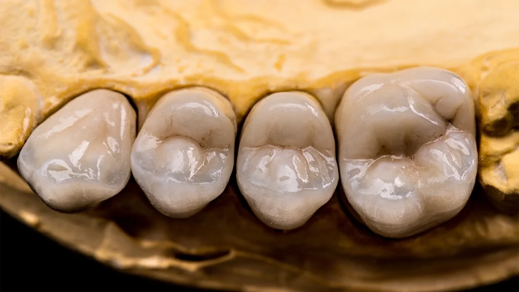 Tooth-colored composite fillings on back teeth