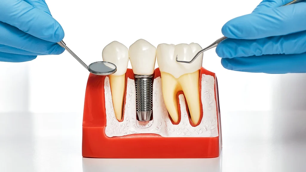 Dental implant, crown, and natural teeth comparison model
