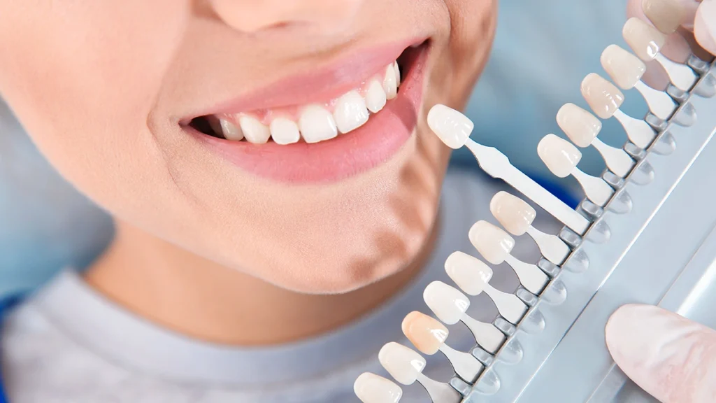 Teeth Whitening Last