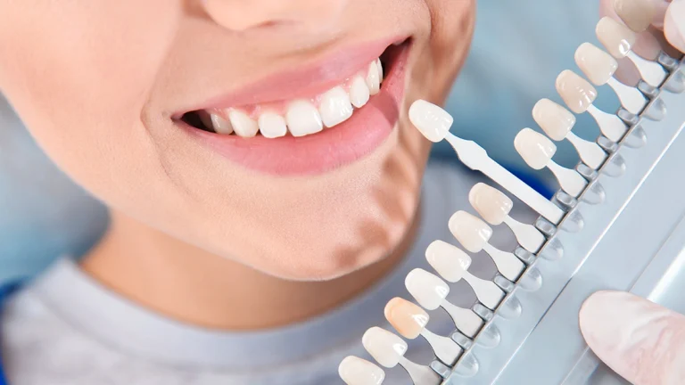 How Long Does Teeth Whitening Last? Results, Aftercare, and When to Repeat Treatment