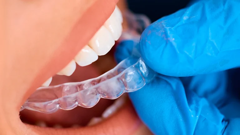 How Much Does Invisalign Cost in Turkey in 2026? Prices, Treatment Time & Quotes
