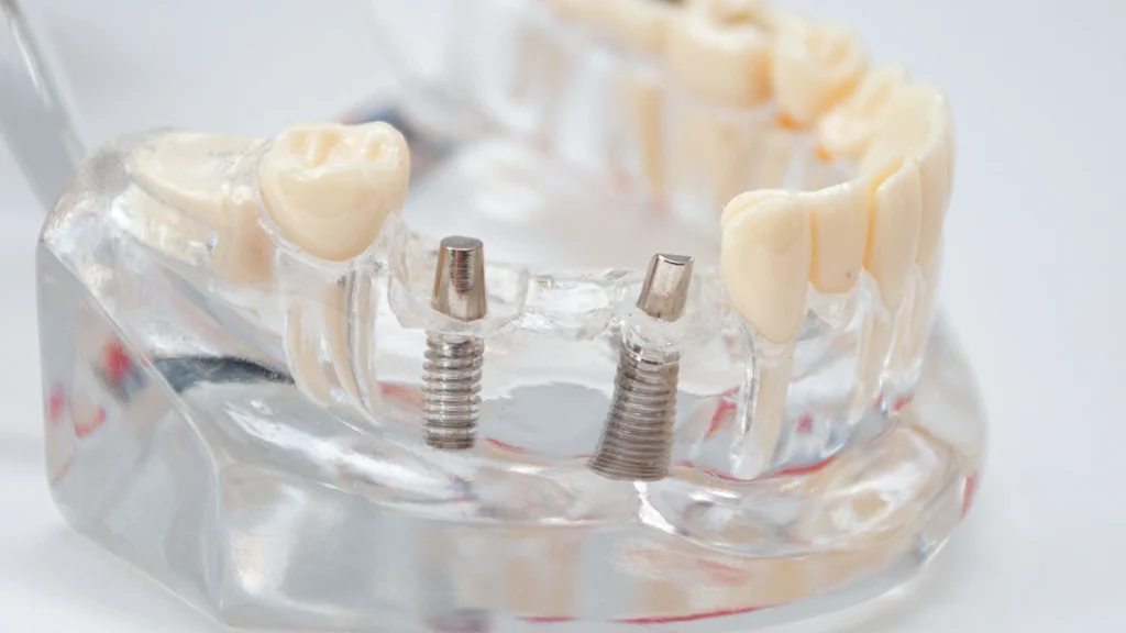 Dental implants with abutments illustrating implant replacement and maintenance