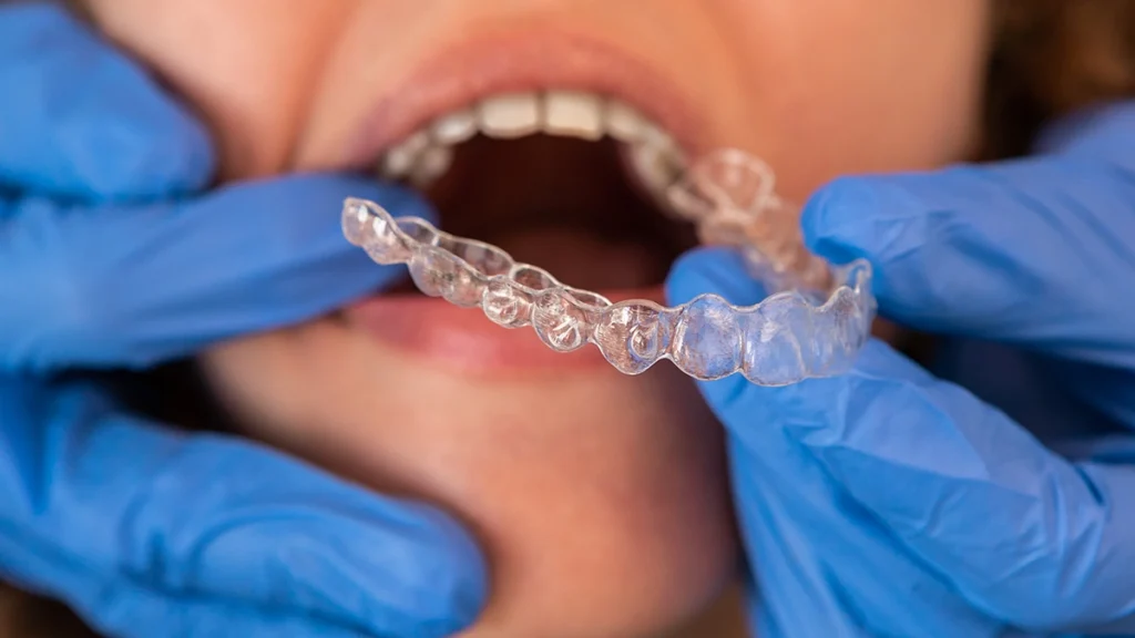 Invisalign clear aligner fitted during orthodontic treatment in Turkey