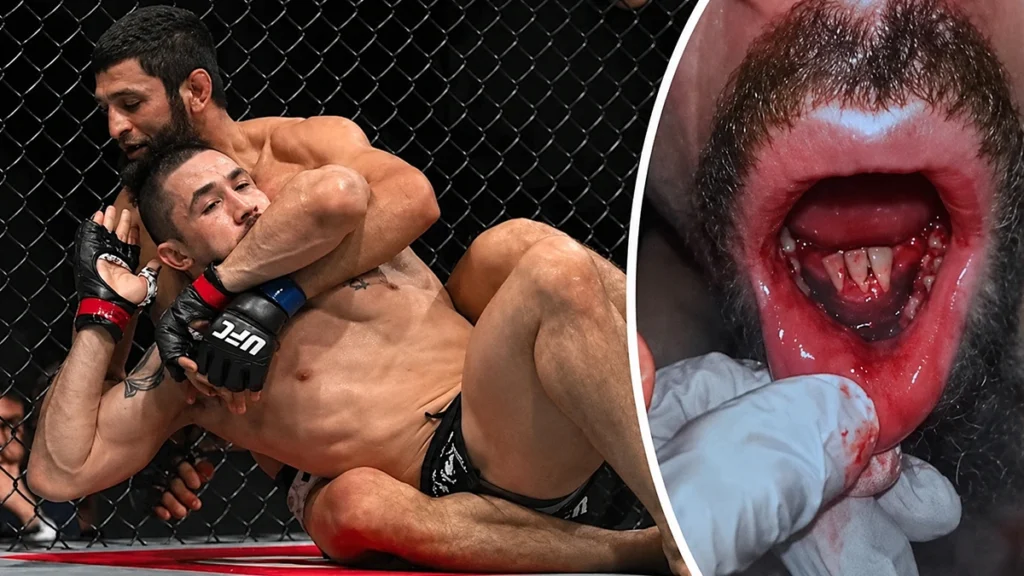 UFC fighter dental injury showing the risk of broken or knocked-out teeth during MMA competition