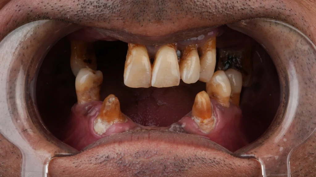 Multiple missing and severely damaged teeth before denture treatment