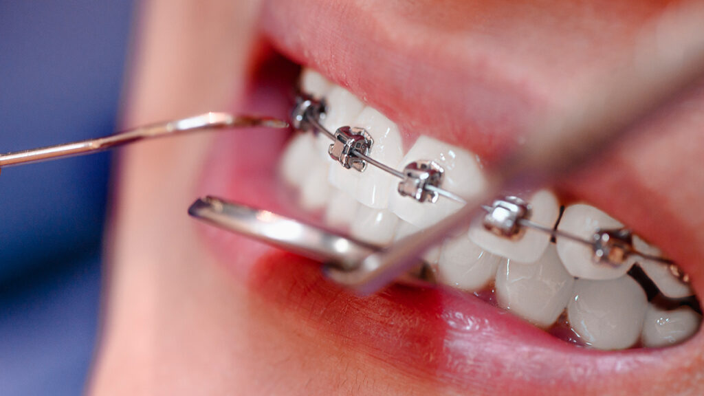 Close-up of orthodontic braces being examined, representing cosmetic and functional dental care for professional athletes.