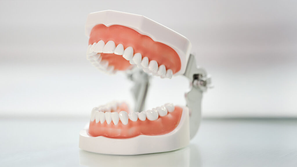 Dental model showing upper and lower teeth, illustrating how a mouthguard protects teeth and jaws during NFL games.