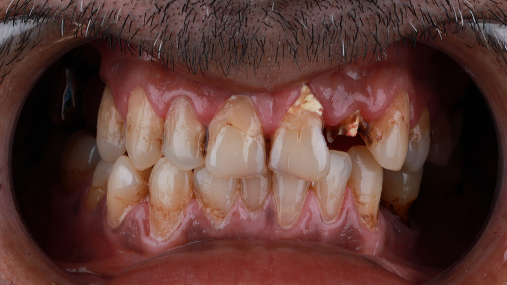 Close-up of severely damaged and missing front teeth, illustrating dental trauma that may occur in American football.