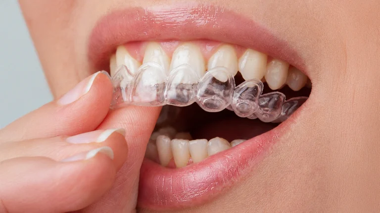 What Can Invisalign Fix? Overbites, Crowded Teeth, Gaps, and More