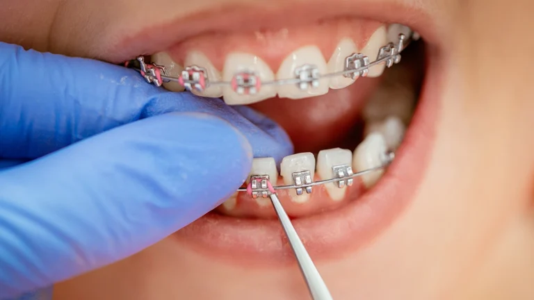 What Is Orthodontic Treatment? Types, Benefits, Costs, and How It Works