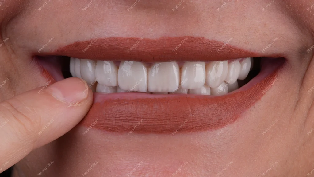 Wide smile showing upper and lower teeth for a 16 or 20 veneer treatment plan