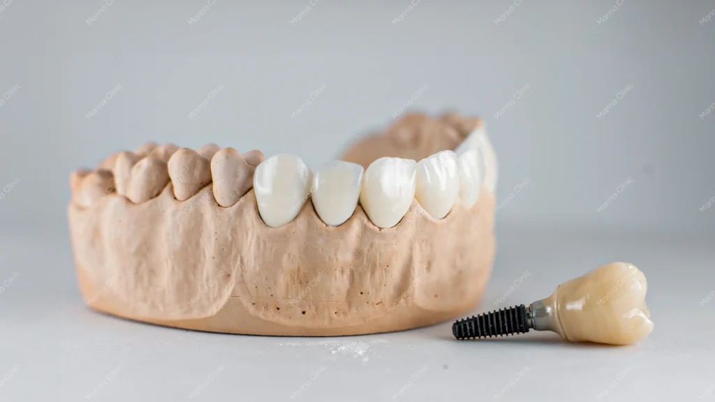 Affordable dental implants with implant-supported crown and dental model