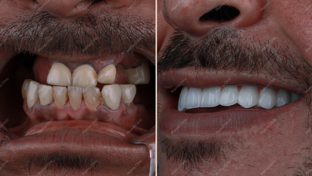 dental implants before and after