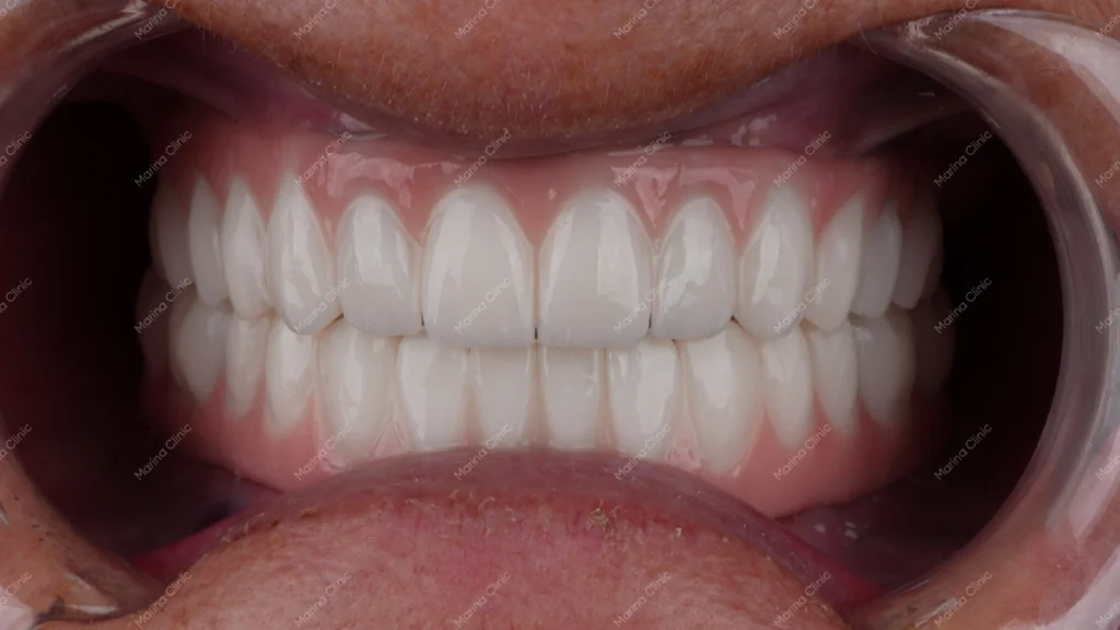 Restored full smile after full-mouth dental implant treatment