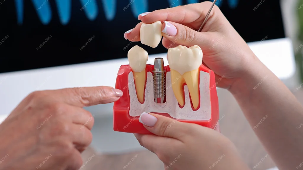 Dental implant timeline model showing implant placement and final crown restoration