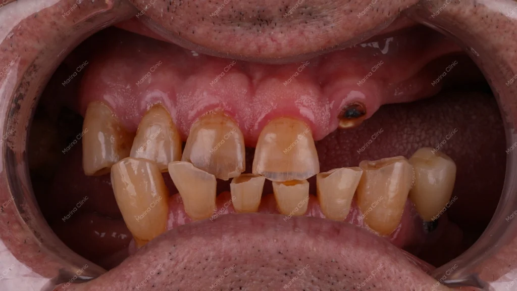 Patient with multiple missing teeth before dental implants or bridge treatment