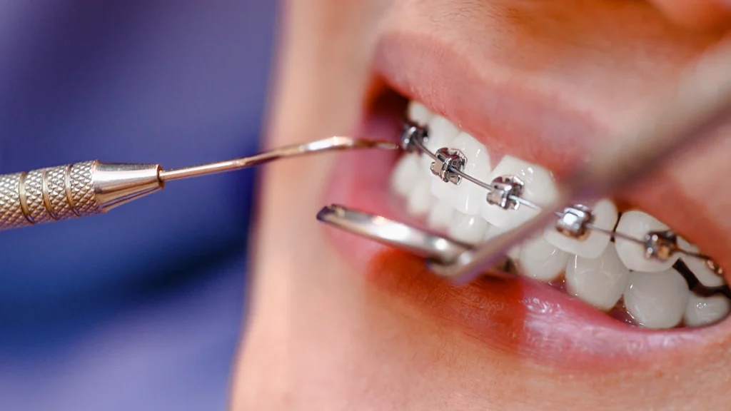 Orthodontic braces treatment for professional athletes and active adults