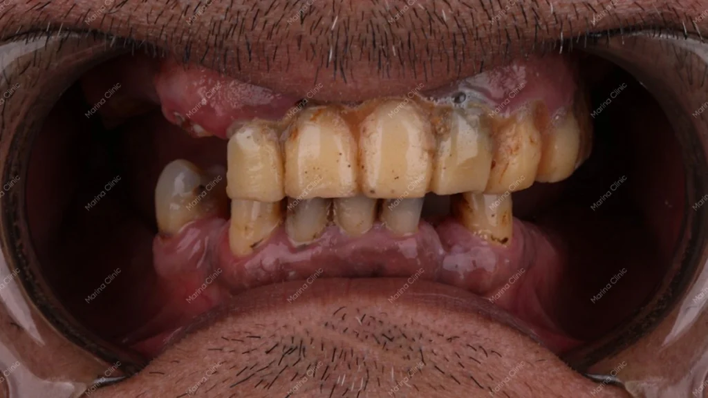 Patient with six missing teeth before dental implant or bridge treatment