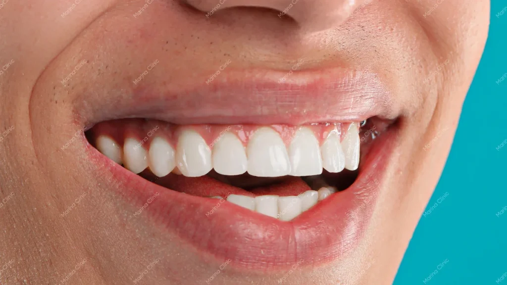 Smile showing visible upper teeth when considering 12 vs 20 veneers