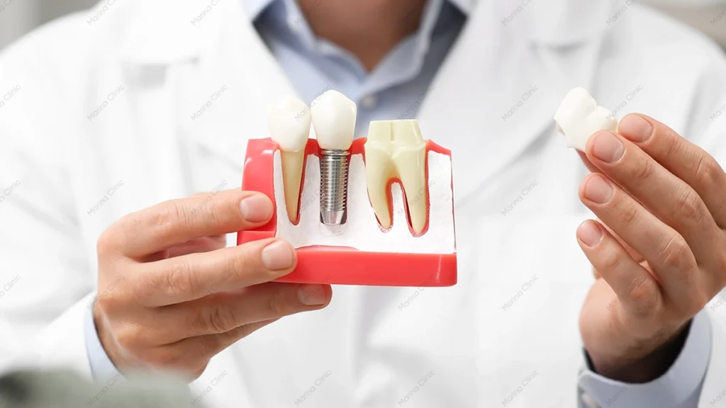 Dental implants before and after treatment model showing a missing tooth replaced with an implant crown