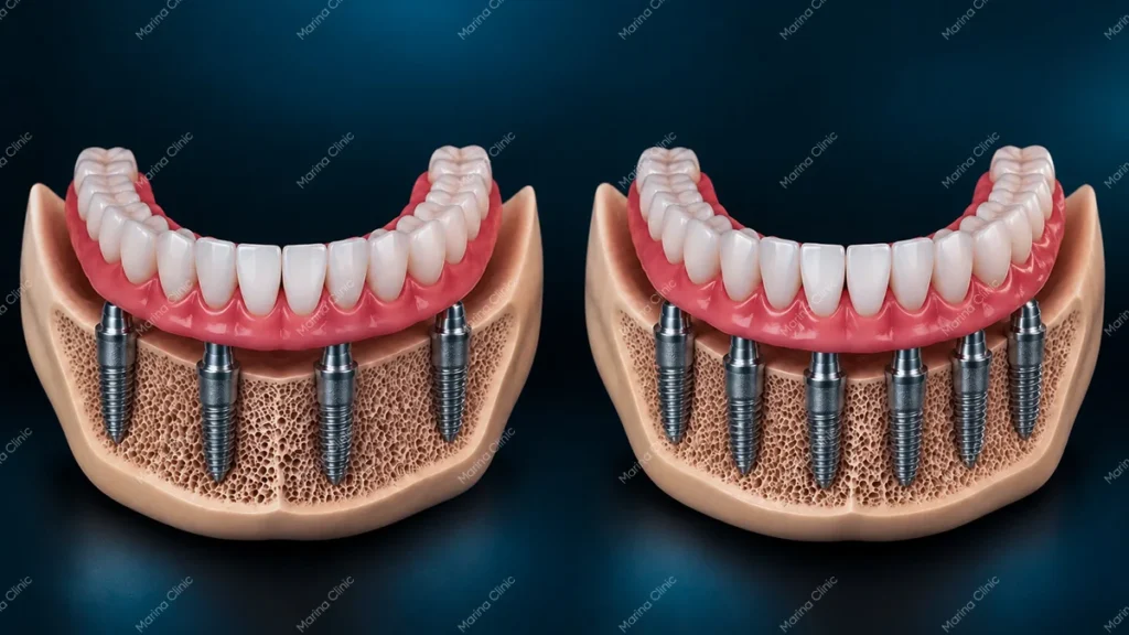 All-on-4 vs All-on-6 dental implant models showing four and six implants supporting full-arch restorations in the lower jaw.