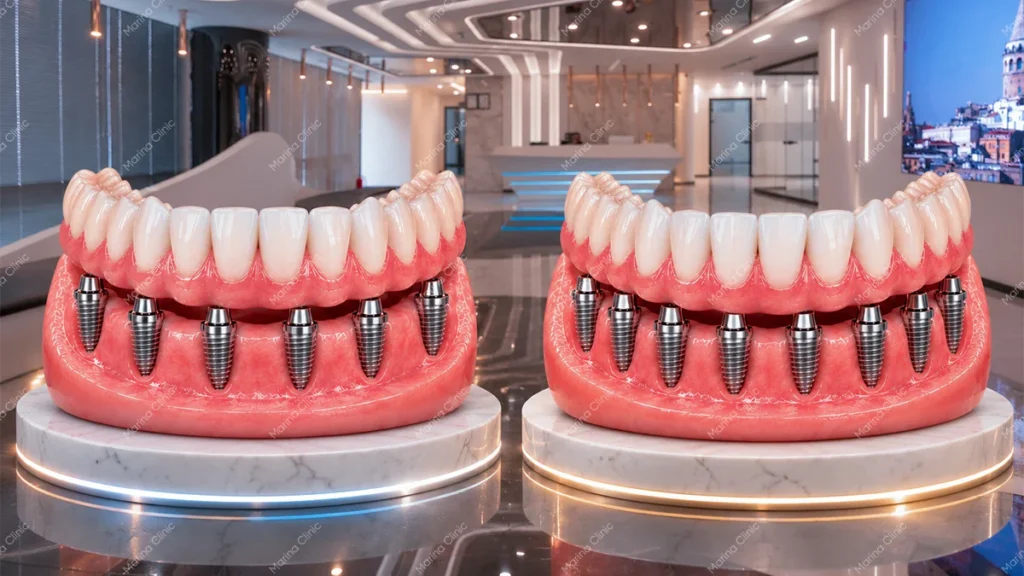 All-on-6 vs All-on-8 dental implants comparison showing fixed full-arch bridges supported by six and eight implants.