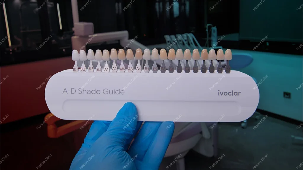 Dental tooth shade guide used for color matching in front tooth bonding and dental crowns to achieve a natural-looking smile.