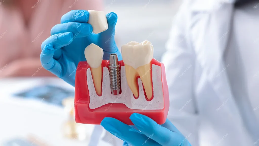 Dental implant model showing implant fixture, abutment, and crown components used in German and Swiss dental implant systems.