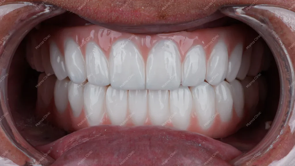 Close-up of a full set of artificial teeth and gums, illustrating full mouth dental implants and implant-supported smile restoration options.