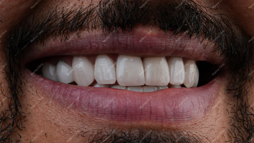 Close-up of a man's smile showing natural upper and lower teeth, illustrating the appearance of a smile when considering a full smile makeover in Turkey.
