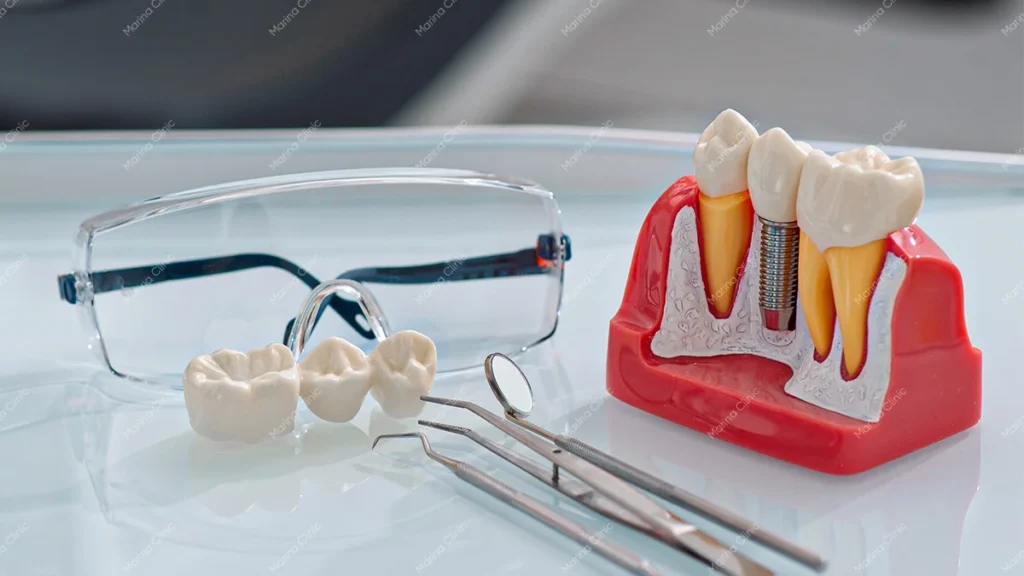 Dental implant model with a prosthetic bridge and dental instruments, illustrating implant-supported dentures vs All-on-4 treatment options.