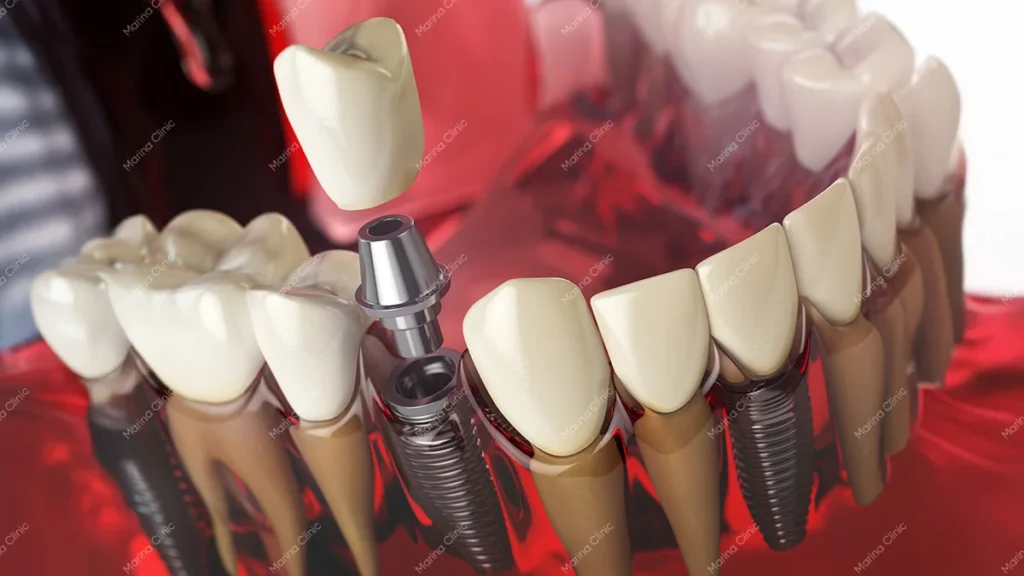 dental illustration showing white dental crowns and titanium implants alongside natural teeth.