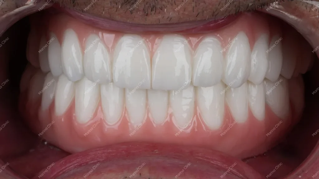 Close-up of full-arch dental restorations showing natural-looking white teeth and pink gums, illustrating implant-supported tooth replacement.