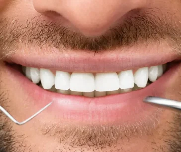 Hollywood Smile in Turkey